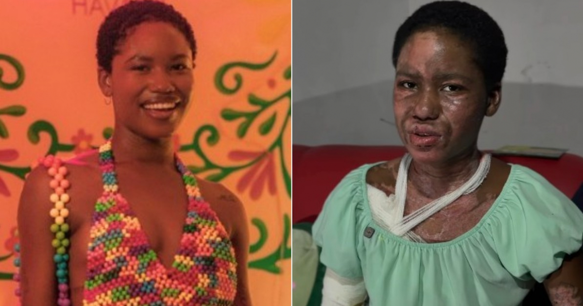 1773076520 Modelo Cubana Habla Tras Sufrir Graves Quemaduras Pensaba Salir Hospital.jpg